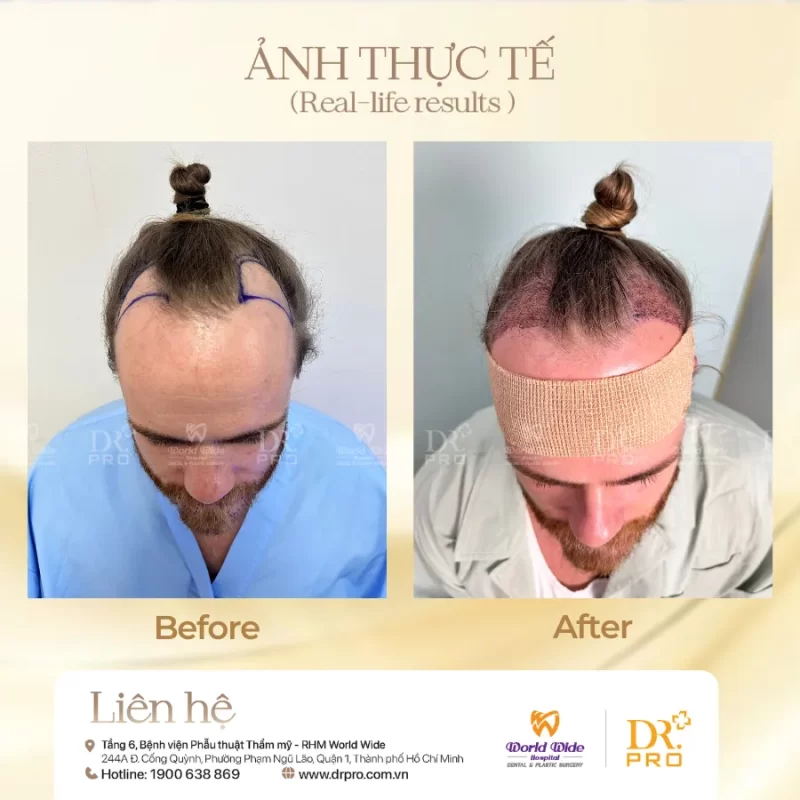 Cấy tóc tự thân