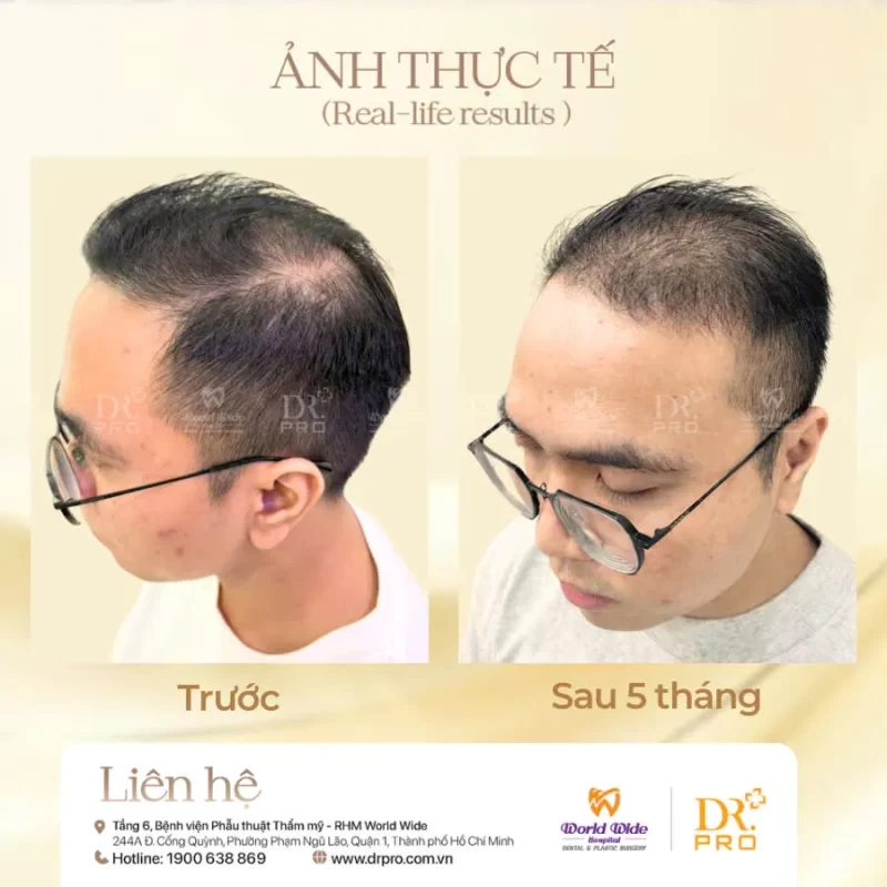 Chăm sóc điều trị tóc