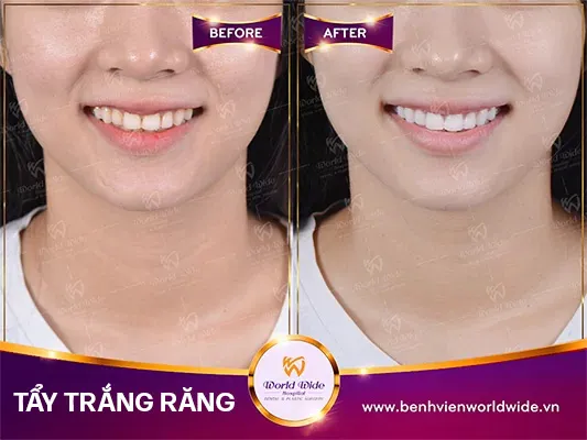 tẩy trắng răng