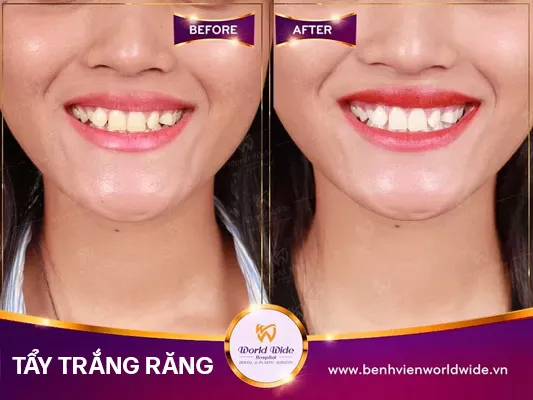 tẩy trắng răng