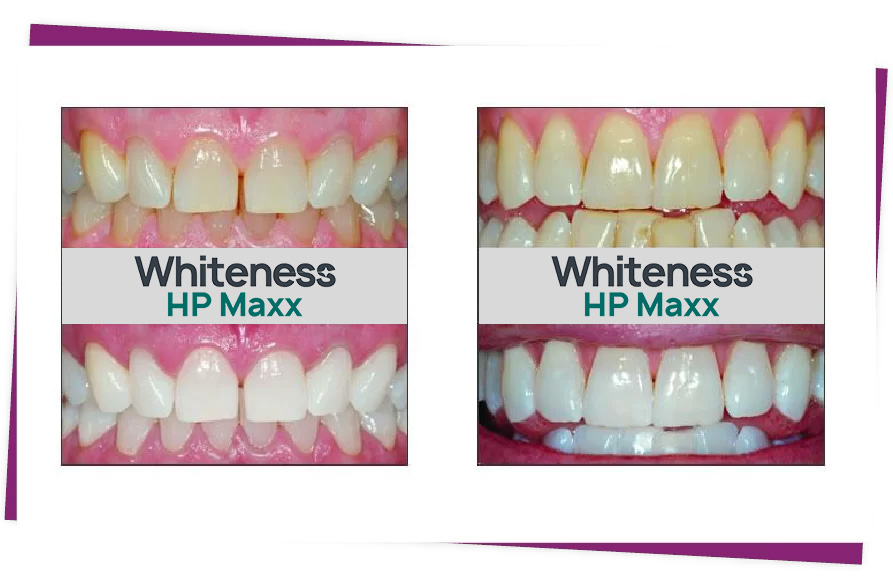 teeth whitening