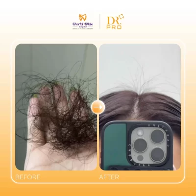ĐIỀU TRỊ DA ĐẦU CHUYÊN SÂU