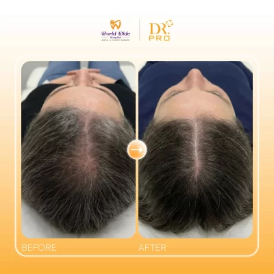 ĐIỀU TRỊ DA ĐẦU CHUYÊN SÂU
