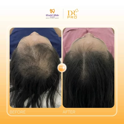 ĐIỀU TRỊ DA ĐẦU CHUYÊN SÂU