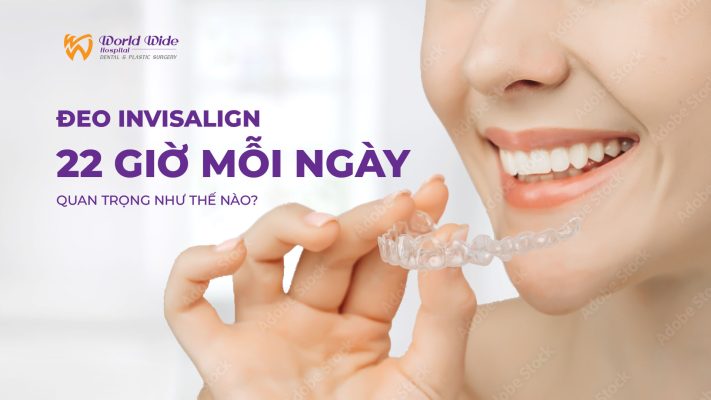 ĐEO INVISALIGN 22 GIỜ MỖI NGÀY QUAN TRỌNG NHƯ THẾ NÀO? ĐIỀU GÌ XẢY RA NẾU BẠN ĐEO KHÔNG ĐỦ THỜI GIAN? VÌ SAO INVISALIGN LUÔN YÊU CẦU ĐEO KHOẢNG 22 GIỜ MỖI NGÀY?