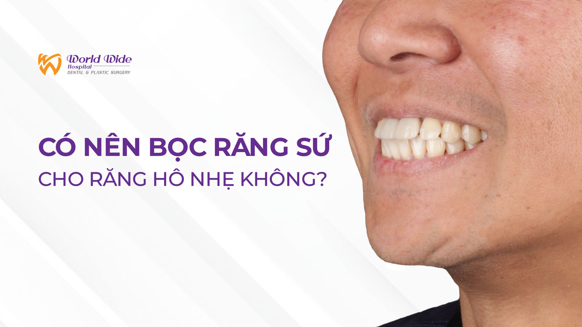 CÓ NÊN BỌC RĂNG SỨ CHO RĂNG HÔ NHẸ KHÔNG? GIẢI PHÁP NÀO PHÙ HỢP NHẤT?