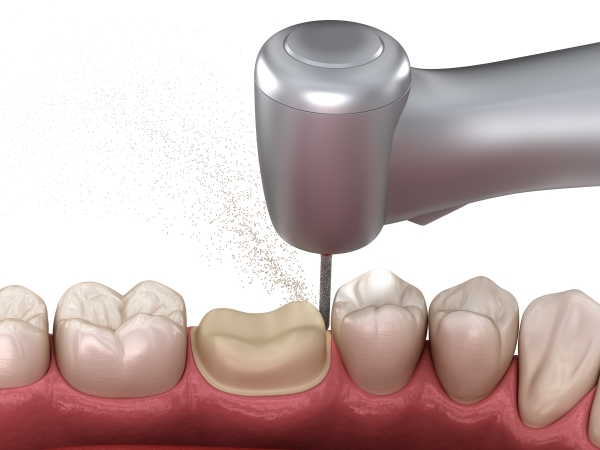 CÓ NÊN BỌC RĂNG SỨ CHO RĂNG HÔ NHẸ KHÔNG? GIẢI PHÁP NÀO PHÙ HỢP NHẤT?