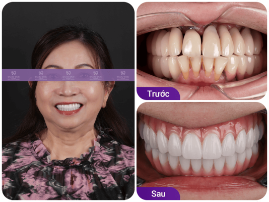 Khách trồng răng implant tại Bệnh Viện Worldwide