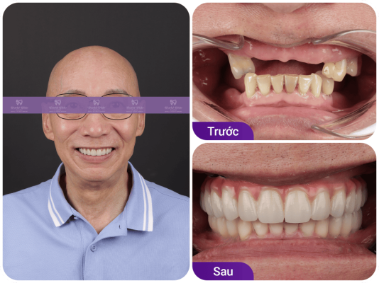 Khách trồng răng implant All on 6 