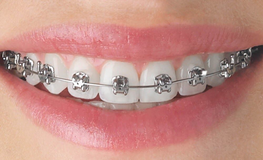 MẮC CÀI DAMON HOẠT ĐỘNG NHƯ THẾ NÀO ĐỂ GIẢM MA SÁT KHI NIỀNG RĂNG?