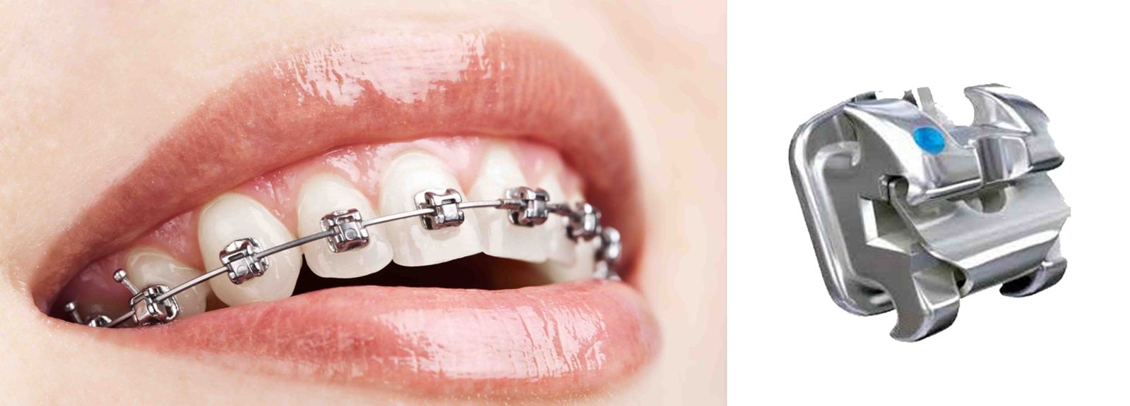MẮC CÀI DAMON HOẠT ĐỘNG NHƯ THẾ NÀO ĐỂ GIẢM MA SÁT KHI NIỀNG RĂNG?