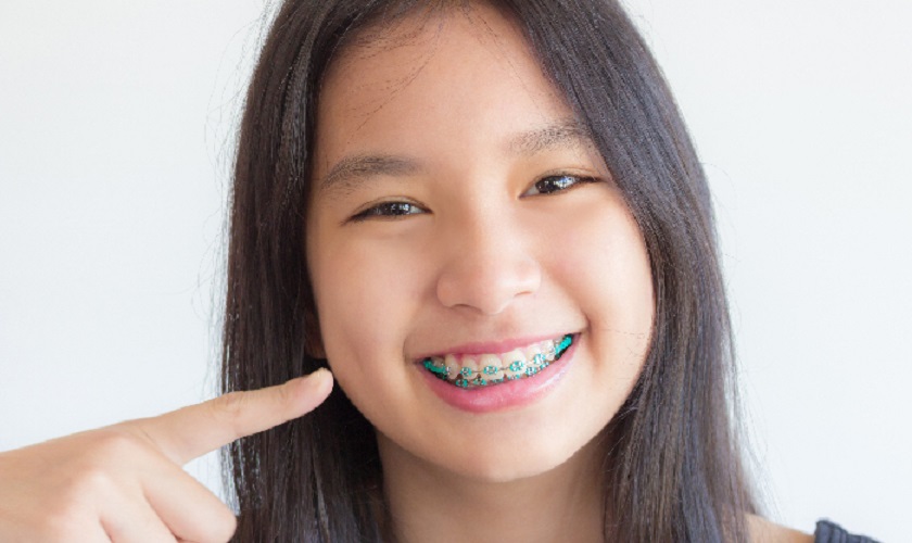 NHỮNG DẤU HIỆU CHO THẤY TRẺ CẦN ĐƯỢC KHÁM CHỈNH NHA SỚM