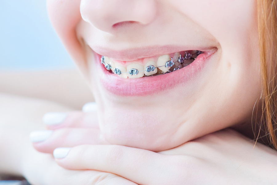 NHỮNG TÌNH TRẠNG KHỚP CẮN NÀO CẦN CAN THIỆP TRƯỚC TUỔI DẬY THÌ?