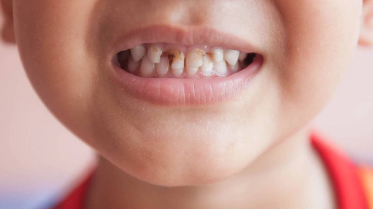 NHỮNG DẤU HIỆU CHO THẤY TRẺ CẦN ĐƯỢC KHÁM CHỈNH NHA SỚM