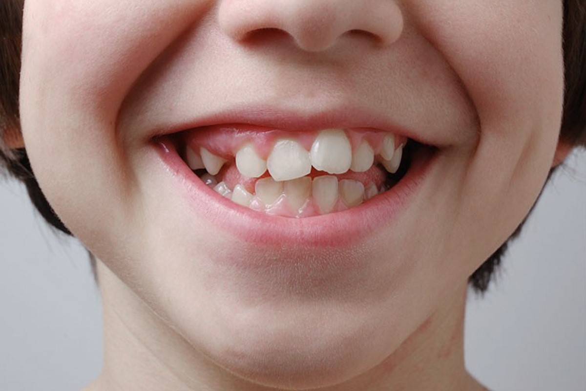 NHỮNG DẤU HIỆU CHO THẤY TRẺ CẦN ĐƯỢC KHÁM CHỈNH NHA SỚM