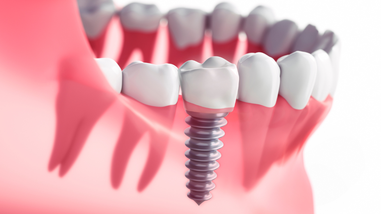 Cấy Ghép Implant