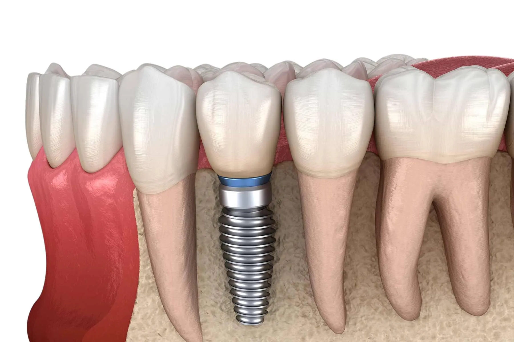 implant don le