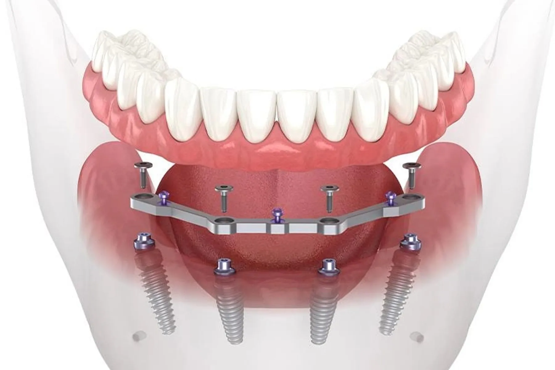 Phục hình trên implant