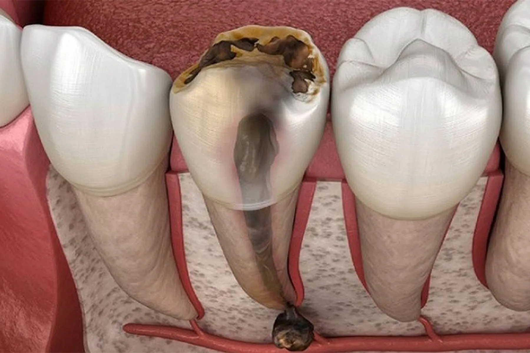 răng hư hỏng