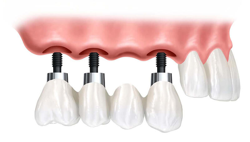 KHI NÀO CẦN NÂNG XOANG ĐỂ CẤY GHÉP IMPLANT? PHÂN BIỆT NÂNG XOANG KÍN VÀ NÂNG XOANG HỞ