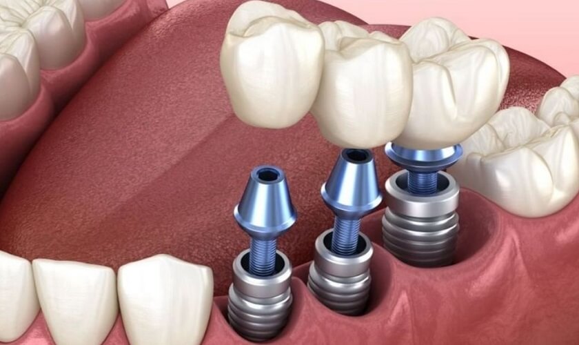 KHI NÀO CẦN NÂNG XOANG ĐỂ CẤY GHÉP IMPLANT? PHÂN BIỆT NÂNG XOANG KÍN VÀ NÂNG XOANG HỞ