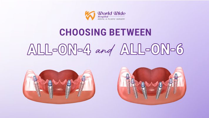 All-on-4 vs All-on-6