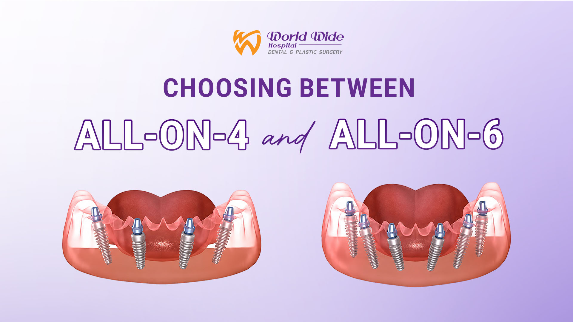 All-on-4 vs All-on-6