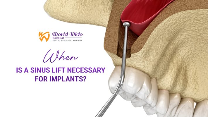 WHEN IS A SINUS LIFT NECESSARY FOR IMPLANTS? CLOSED VS. OPEN EXPLAINED