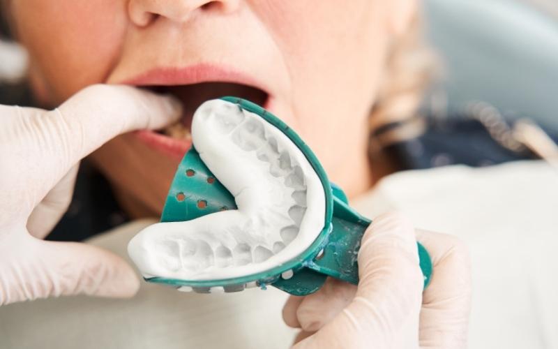 CÓ BAO NHIÊU PHƯƠNG PHÁP LẤY DẤU RĂNG? ƯU VÀ NHƯỢC ĐIỂM CỦA TỪNG PHƯƠNG PHÁP